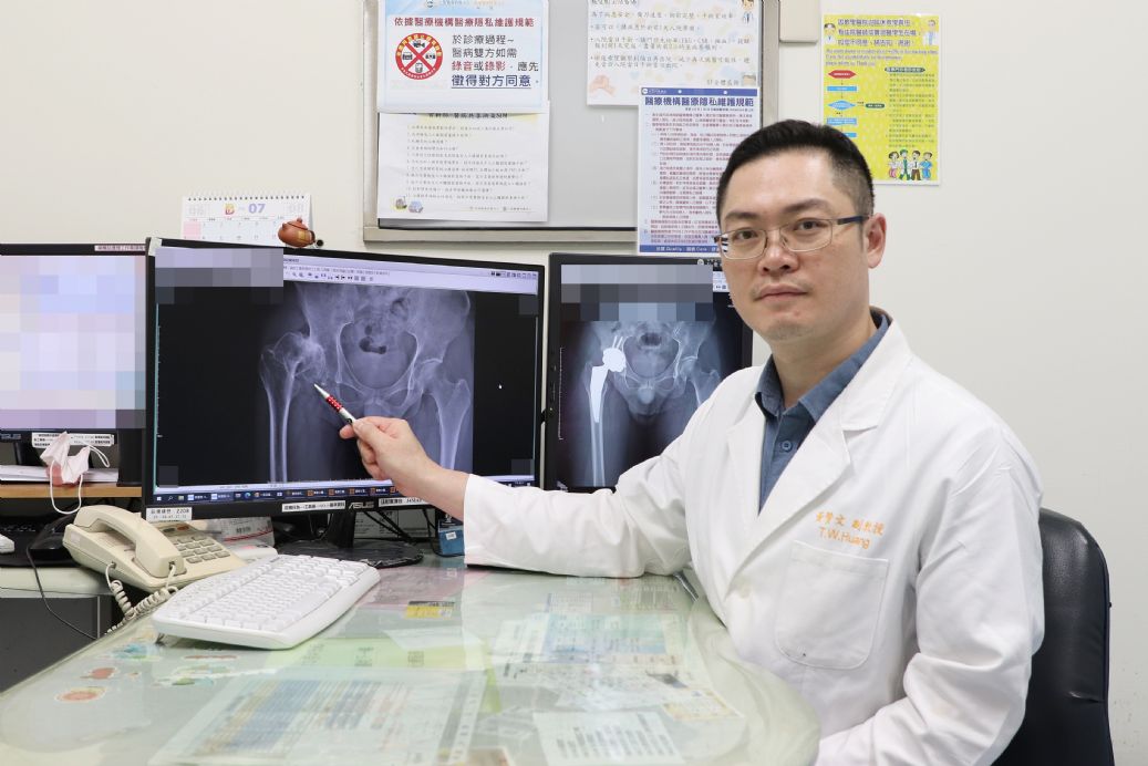 黃贊文醫師指出，病患右側髖關節骨折癒合不良造成髖關節嚴重關節炎及長短腳。