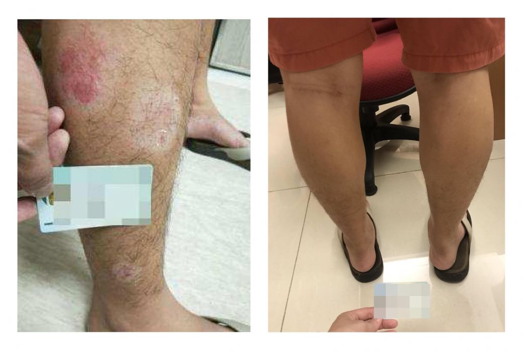 L男雙腳患有乾癬，治療前(左圖)與治療後(右圖)的對照，症狀已明顯改善。