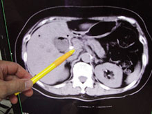 胰臟是長形扁平的腺體，位於左上腹部的後腹膜腔內