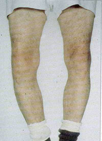 圖一：膝關節的退化性關節炎