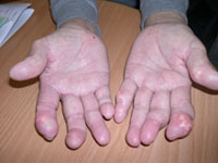 圖二：多處手部關節有痛風石沉積