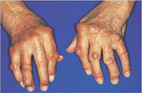 圖三：未積極治療而造成手部關節變形的類風濕性關節炎