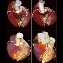 心臟血管照影影像
