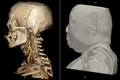 頭頸部骨骼、血管影像