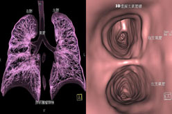 虛擬支氣管鏡