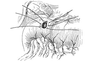 圖二： 手術潰瘍穿孔縫合