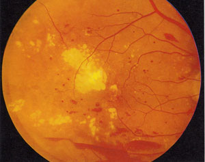 非增生性糖尿病性視網膜病變合併黃斑部脂質滲出