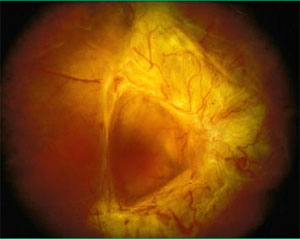 未經治療增生性糖尿病視網膜病變產生網膜嚴重纖維化變形
