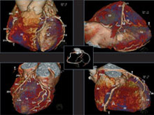 心臟冠狀動脈電腦斷層