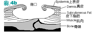 壓瘡第四級圖b