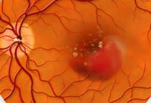 濕式老年性黃斑部病變：呈現黃斑部出血，視力嚴重喪失